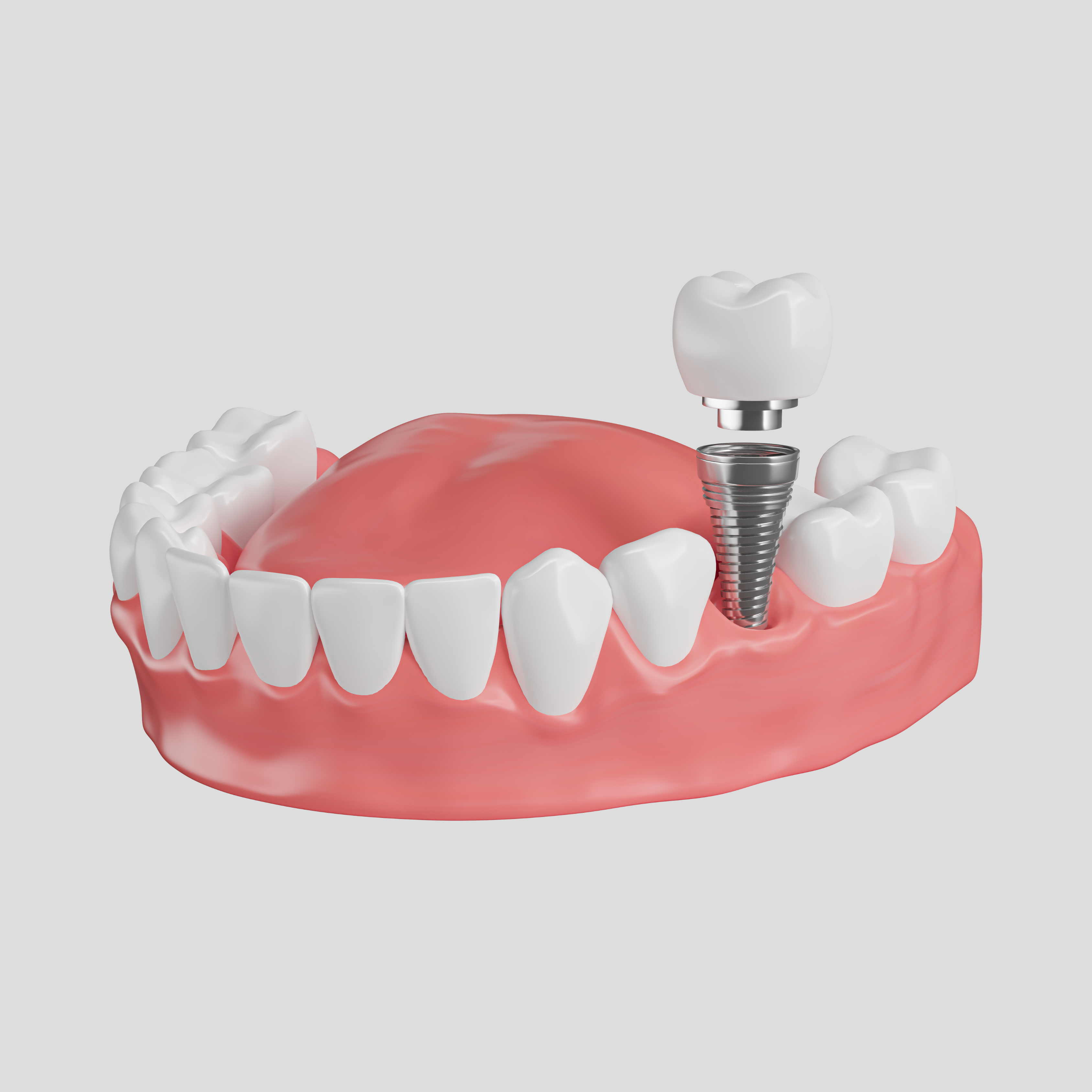Paziente durante la consulenza per un impianto dentale presso Bclinic