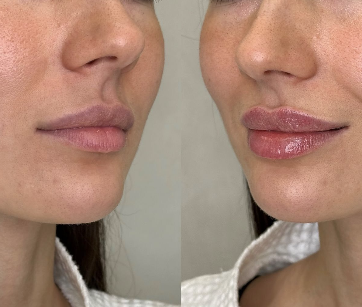 Testo alternativo Impara come descrivere lo scopo dell'immagine(si apre in una nuova scheda). Lascia vuoto se l'immagine è puramente decorativa.Titolo lip filler bclinic Didascalia Descrizione